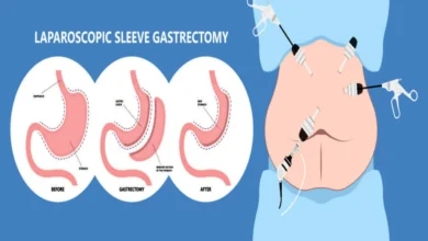 علاج السمنة فإن الخيار الجراحي الأمثل لإدارة الوزن هو تكميم المعدة