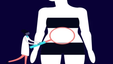 جراحات السمنة تكميم المعدة أفضل استراتيجيات التغلب على الوزن الزائد