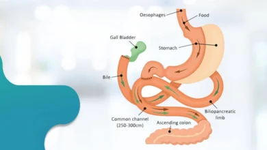 جراحات السمنة ومن أفضل العمليات الجراحية عملية الساسي
